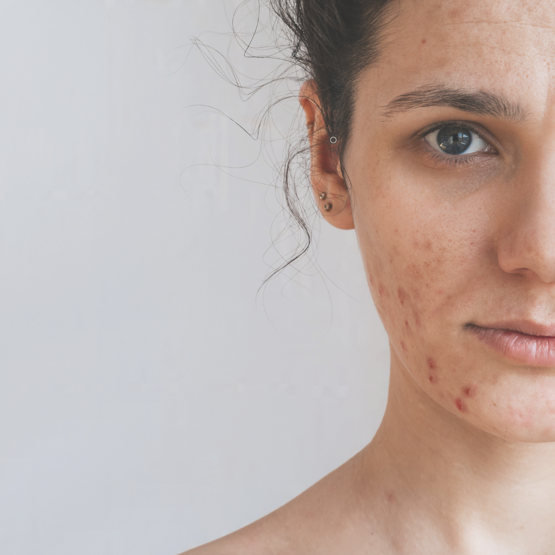 acne, blemish prone skin, pore care