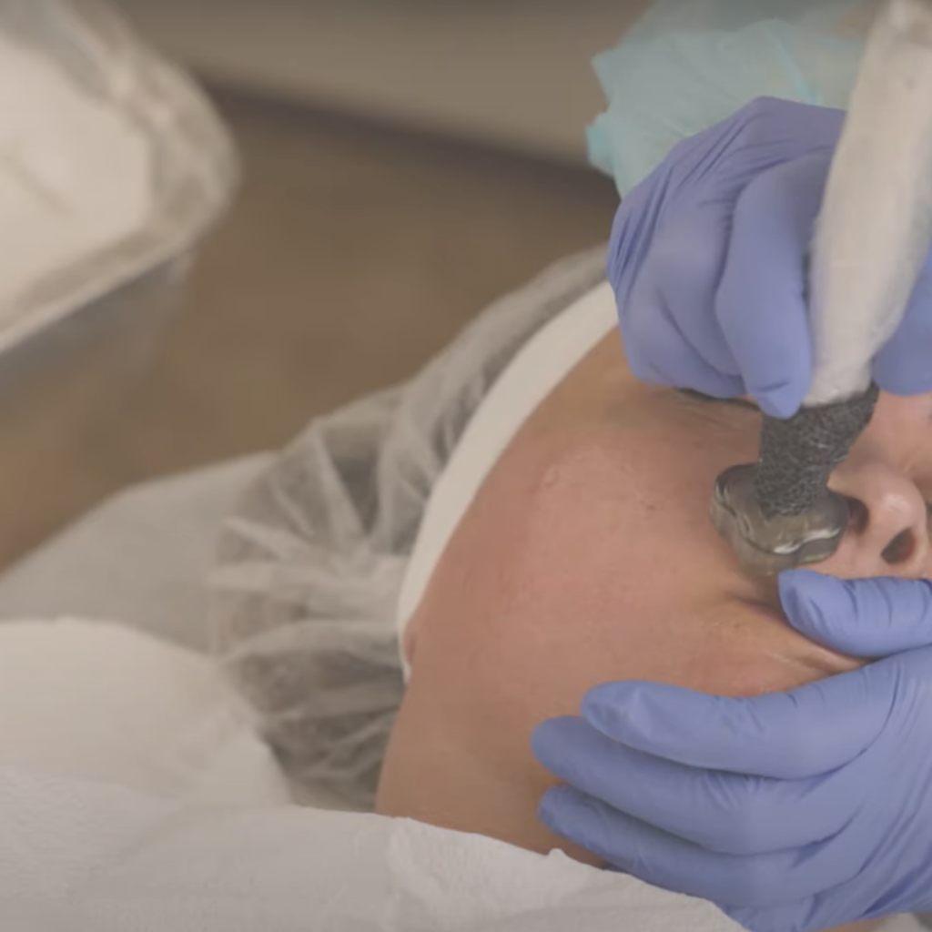 Microneedling, Microchanenling skin needling, derma pen
