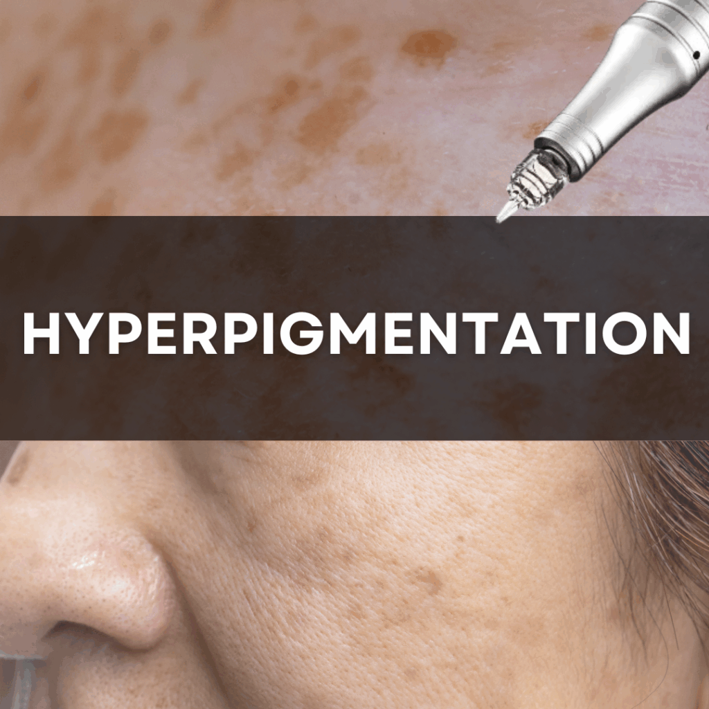 Channel Pro Microchanneling Exosome Hyperpigmentation treatment protocol