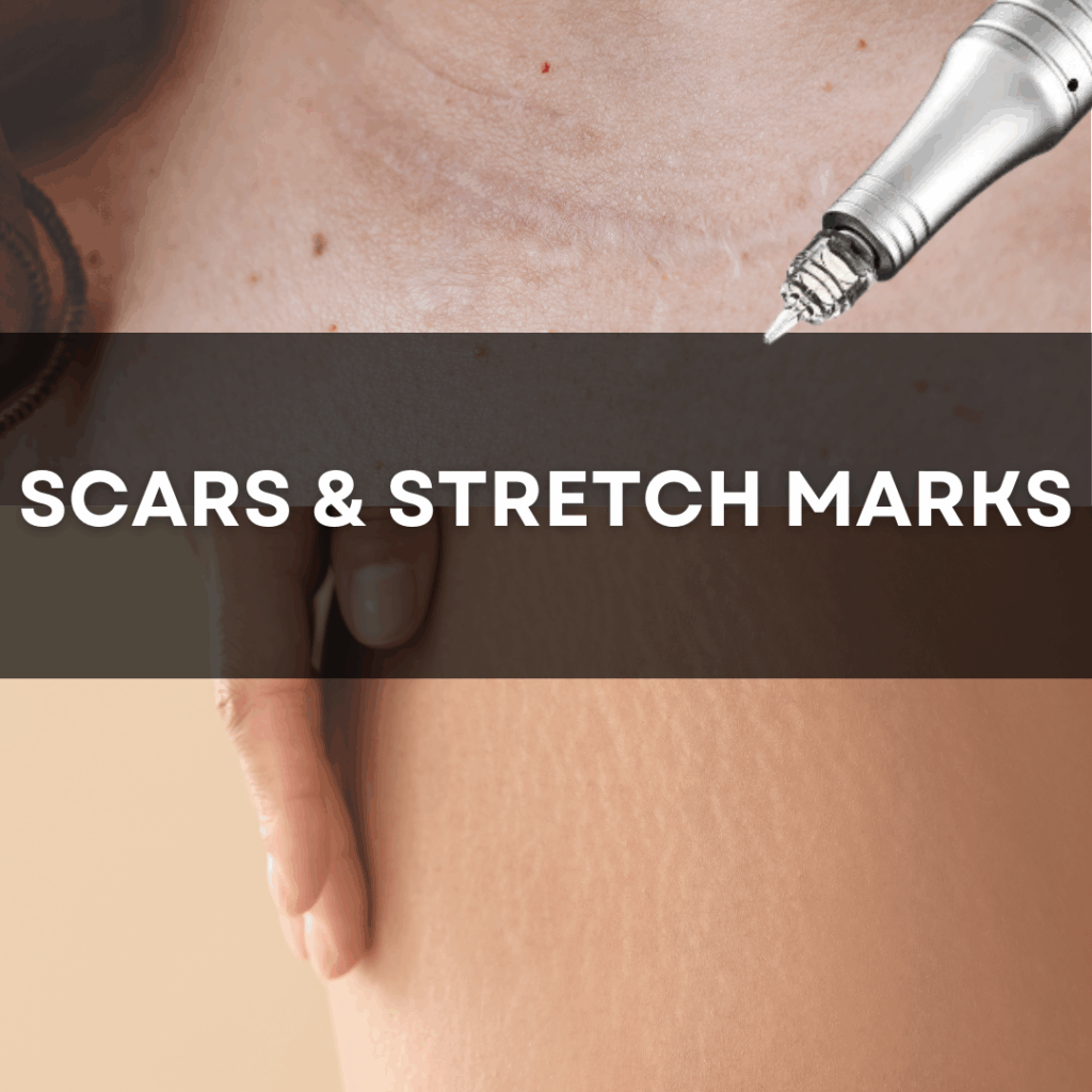 Channel Pro Microchanneling Exosome Scars & Stretch marks treatment protocol